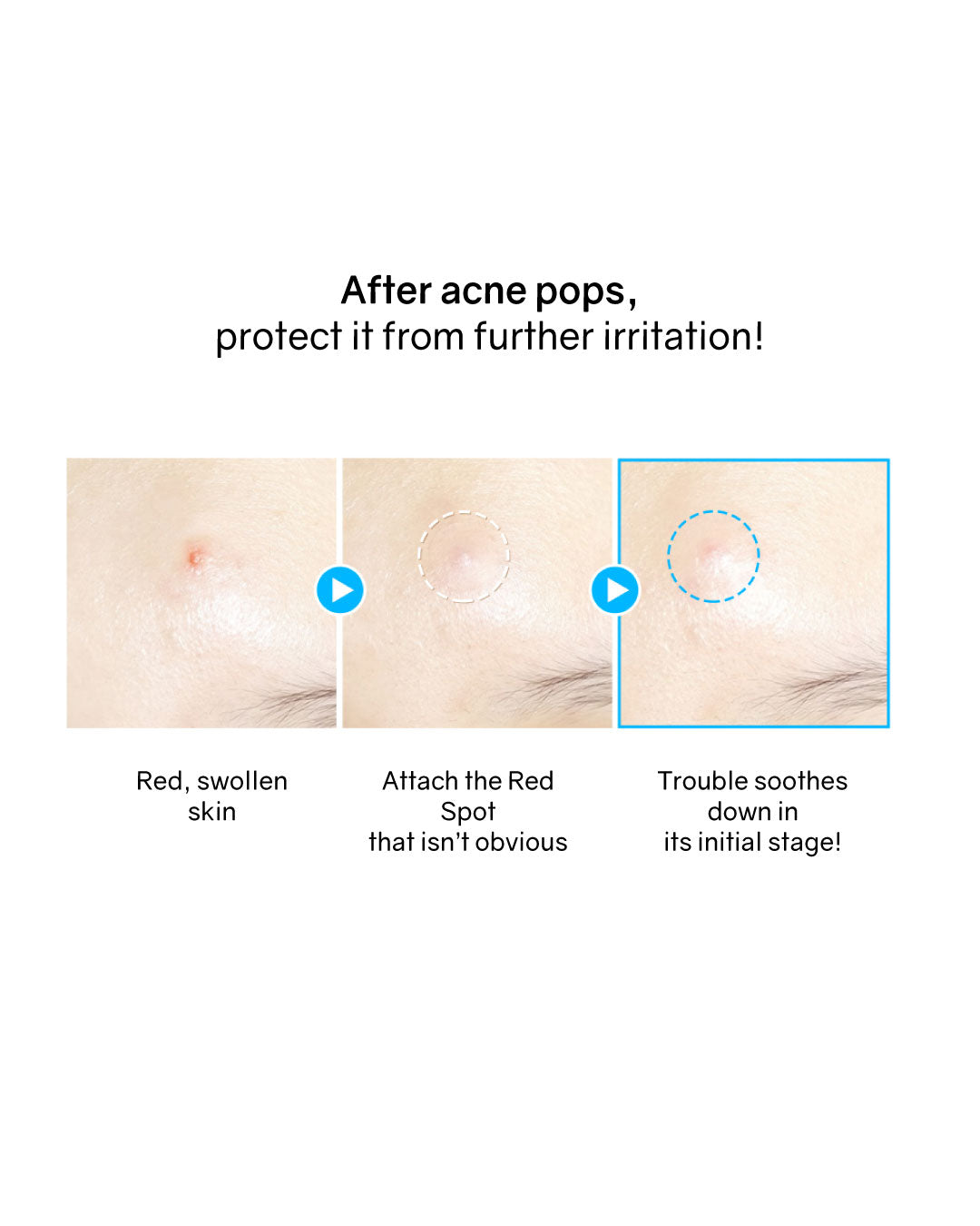 Hatherine Spot Care Patch Kit (76 patches)